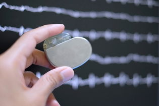 Illustrative image of the article What Is a Pacemaker (How It Works & Surgery Considerations)