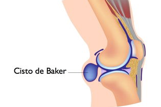 Imagen ilustrativa del artículo Quiste de Baker: síntomas, causas y tratamiento 