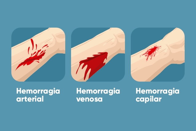 Hemorragia: o que é, tipos e o que fazer - Tua Saúde