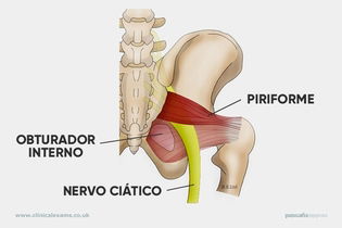 Imagem ilustrativa do artigo Síndrome do piriforme: o que é, sintomas, testes e tratamento