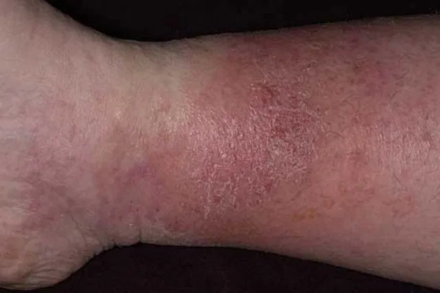 symptômes de dermatite de stase