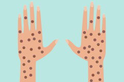 Imagem ilustrativa do artigo Prurigo nodular: o que é, causas, principais sintomas e tratamento