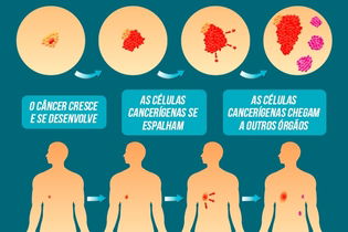 Imagen ilustrativa del artículo Qué es la metástasis, síntomas y cómo ocurre