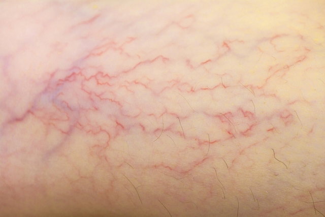 Telangiectasias Qu Son Causas Y Tratamiento Tua Sa de Telangiectasias Qu Son Causas Y Tratamiento Tua Sa de