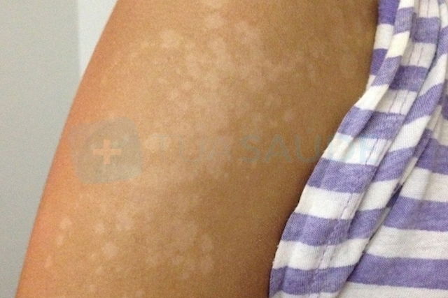 image montrant le pityriasis versicolor sur la peau