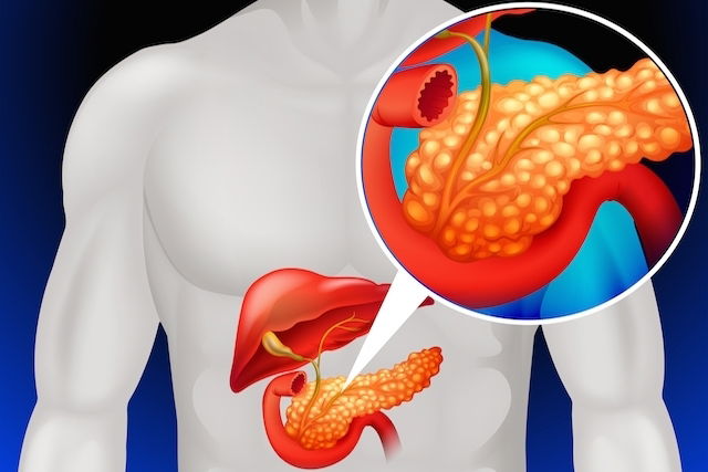 Imagen ilustrativa del artículo Pancreatitis (aguda y crónica): qué es, síntomas y tratamiento 