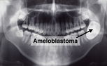 Imagem ilustrativa do artigo Ameloblastoma: o que é, sintomas, tipos e tratamento
