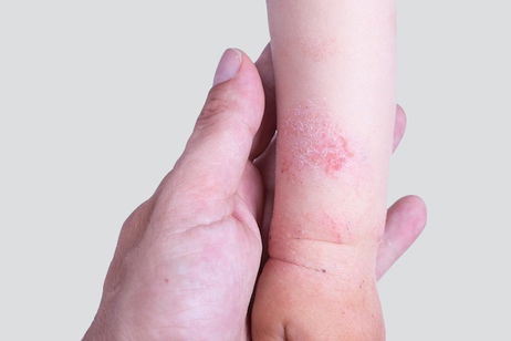Image illustrative de l'article Dermatite atopique: symptômes, causes et traitement