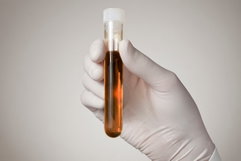 Illustrative image of the article Black Urine: 8 Main Causes & What to Do
