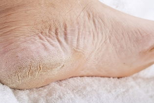 Image illustrative de l'article Pieds qui pèlent : 5 causes principales (et ce qu'il faut faire)