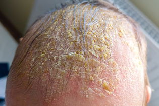 Illustrative image of the article Cradle Cap: Symptoms, Causes & Treatment