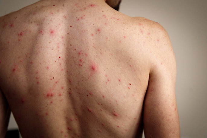 chicken pox rash on man's back