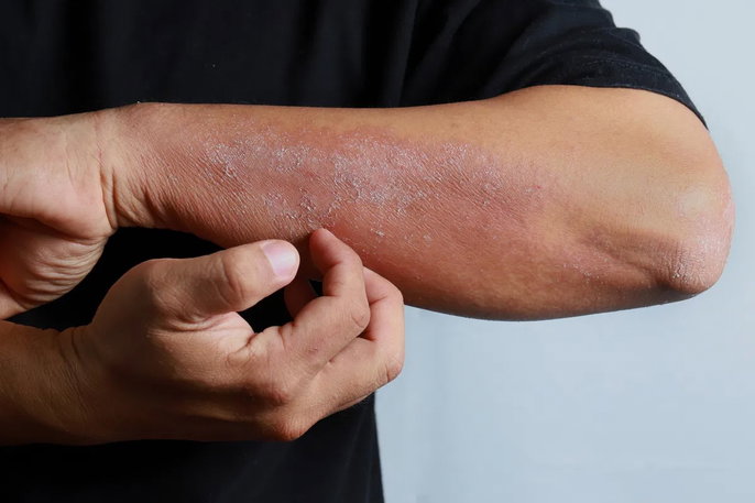 eczema