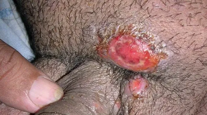 Granuloma infuinal