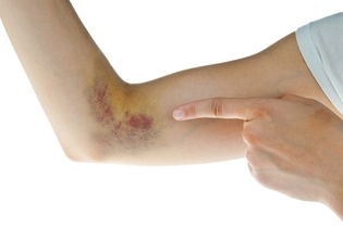 Illustrative image of the article 6 Ways to Get Rid of Bruises (Home Care & When to See a Doctor)