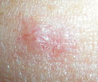 Image illustrative de l'article 5 signes d'alerte de cancer de la peau 