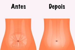 Imagem ilustrativa do artigo Tudo sobre a cirurgia para curar a Diástase Abdominal