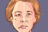 Imagem ilustrativa do artigo Paralisia facial: o que é, sintomas, causas e tratamento