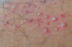 Imagen ilustrativa del artículo Bolitas en los labios mayores: 11 causas y qué hacer (con fotos)