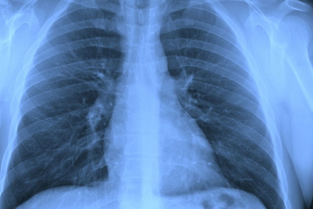 Agua en los pulmones: síntomas, ¿es grave? y tratamiento - Tua Saúde