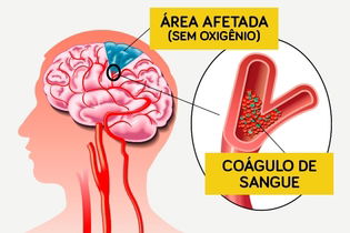 Imagem ilustrativa do artigo Trombose cerebral: o que é, sintomas, causas e tratamento