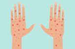 Illustrative image of the article Scabies: Symptoms, Transmission & Treatment (w/ Home Remedies)