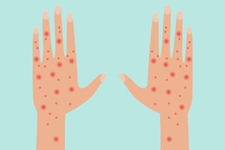 Illustrative image of the article Scabies: Symptoms, Transmission & Treatment (w/ Home Remedies)