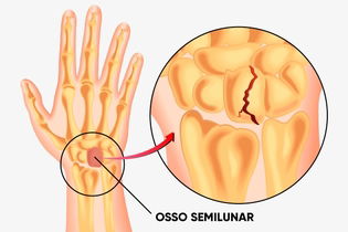 Imagem ilustrativa do artigo Doença de Kienbock: o que é, sintomas e tratamento