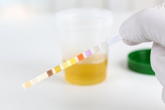Proteína na urina na gravidez: causas e o que fazer - Tua Saúde