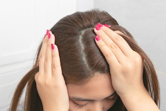 Illustrative image of the article How to Get Rid of Dandruff: Shampoo, Medication & More 