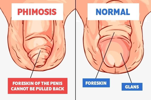 Illustrative image of the article Phimosis Surgery: How It's Done, Benefits, Recovery & Risks