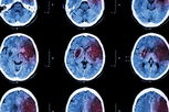 Imagen ilustrativa del artículo Hemorragia cerebral: síntomas, secuelas, causas y tratamiento 