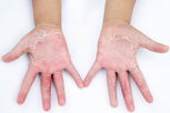 Illustrative image of the article Rash on Hands: Causes, Symptoms & Treatment