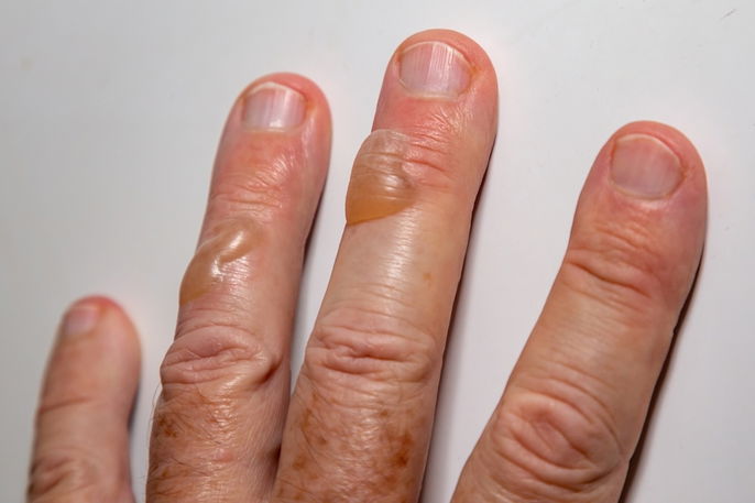 Quemadura com ampolla de segundo grado