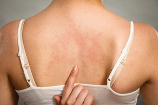 Illustrative image of the article Cholinergic Urticaria: Symptoms, Causes & Treatment