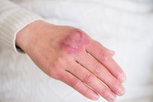 Illustrative image of the article Chilblains: Symptoms, Causes & Treatment