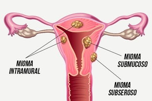 Imagem ilustrativa do artigo 8 principais sintomas de mioma uterino