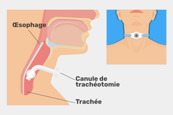 Image illustrative de l'article Trachéotomie: c'est quoi, à quoi ça sert, types (et réalisation)