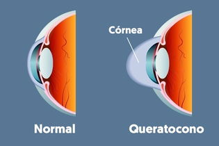 Imagen ilustrativa del artículo Queratocono: qué es, síntomas, tratamiento y cirugía