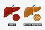 Imagem ilustrativa do artigo Esteatose hepática: o que é, graus, sintomas e tratamento