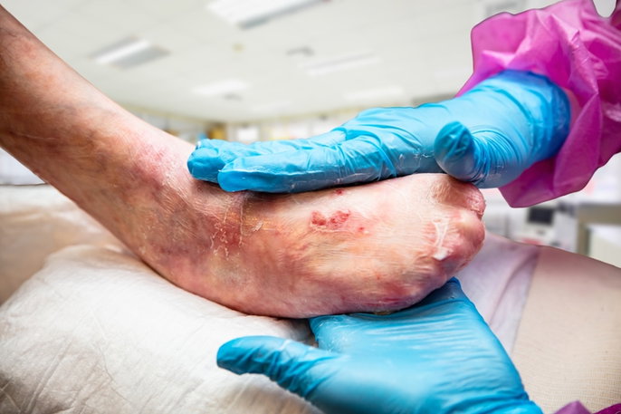 Médico realizando curaciones en una persona con piel de mariposa