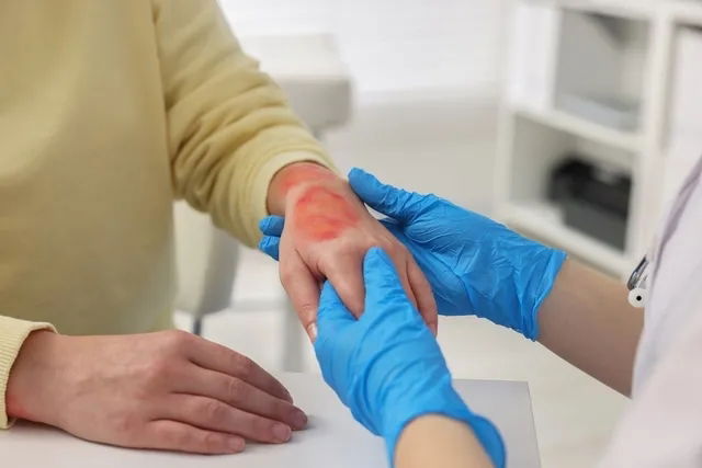 Mujer en dermatólogo con quemadura en la mano