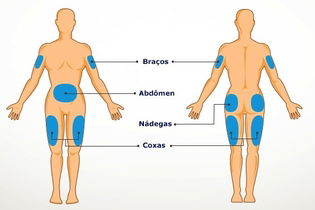 Imagem ilustrativa do artigo Como aplicar insulina com caneta ou seringa (e locais de aplicação)