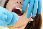 Imagem ilustrativa do artigo Quando posso voltar a comer depois de tirar um dente?