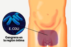 Imagen ilustrativa del artículo Gangrena de Fournier: qué es, causas y tratamiento