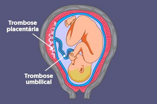 Imagem ilustrativa do artigo Trombose placentária: o que é, sintomas, causas e tratamento