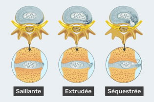 Image illustrative de l'article Hernie discale: types, symptômes, causes et traitement