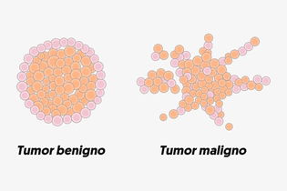 Imagem ilustrativa do artigo Neoplasia: o que é, sintomas e diferença entre maligno ou benigno