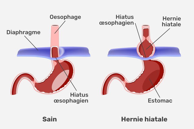 illustration montrant un estomac sain et un estomac avec une hernie hiatale