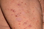 Illustrative image of the article Red Spots on Skin: 19 Common Causes & Treatments